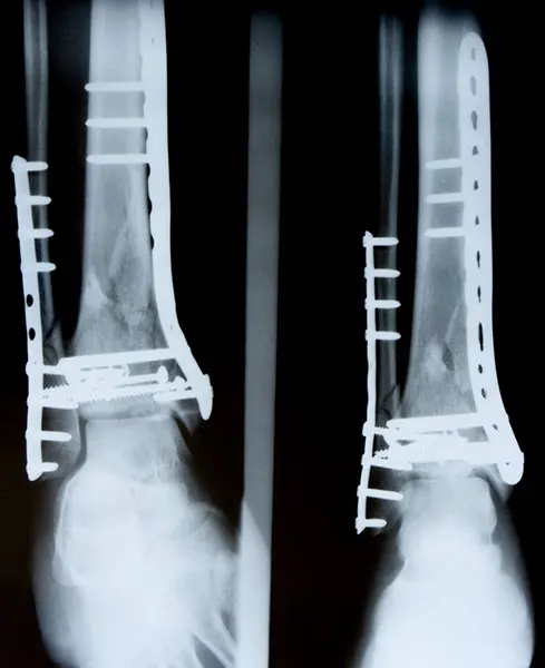 astm-f384-metallic-orthopedic-fixation-device-testing-cover ASTM F384 Testing