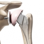 Artificial Should Implant close up