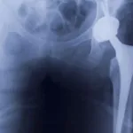 hip implant xray